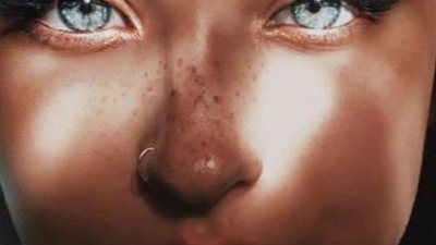 النمش التجميلي: لمسة فنية تعزز جمال البشرة