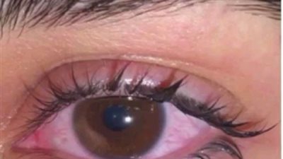 مرض التراخوما عدوى تصيب العين لنتعرف على بكتيريا المتدثرة الحثرية التي تسببه