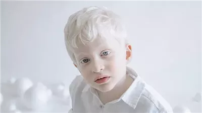البرص مرض جلدي نادر الأسباب