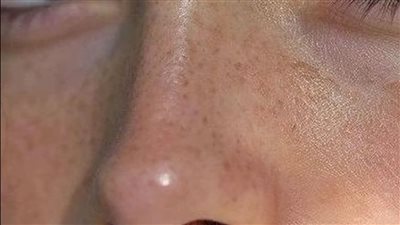 خلطات طبيعية لعلاج الأنف الدهني والتحكم في أعراضه