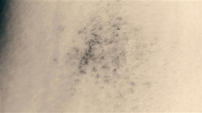العلامات الزرقاء على الجلد : دلالة صحية هامة لا ينبغي إغفالها